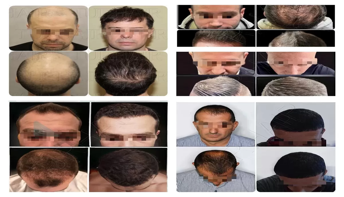 Комбинация от лукс и здраве Турция и услугите на Turhair